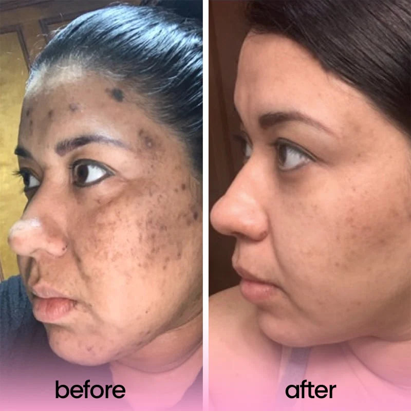 TURMERIC & KOJIC ACID PADS ( Buy 1 Get 1 Free)